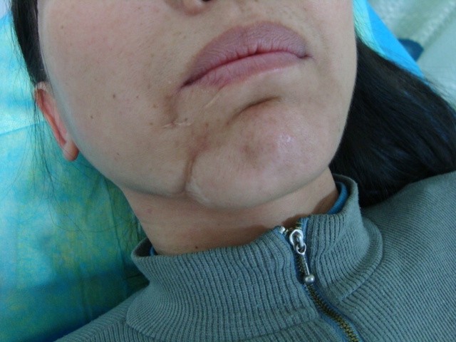 凹陷5.JPG 凹陷5.JPG