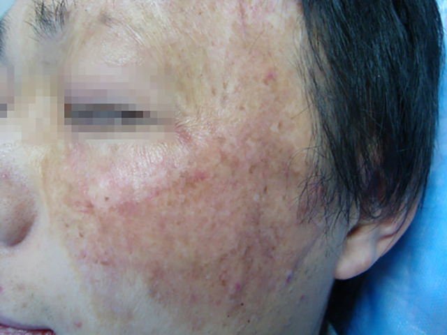 凹陷5.JPG 烧伤疤痕