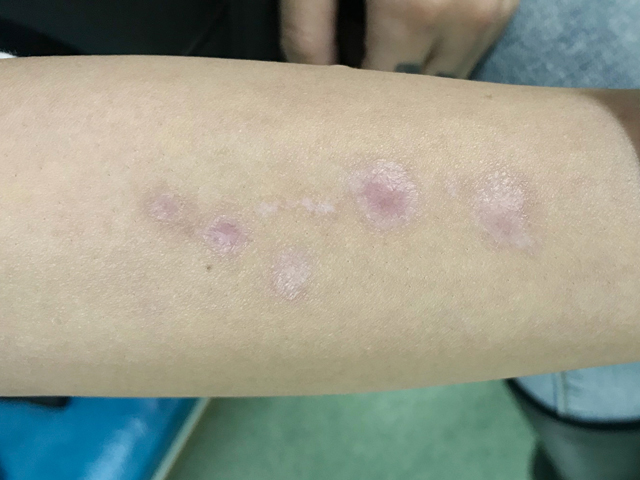 凹陷5.JPG 烧伤疤痕