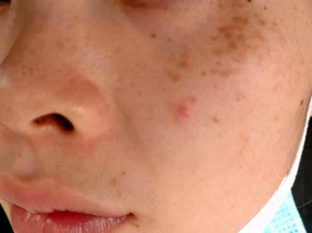 凹陷5.JPG 褐青色痣